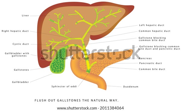 Gallstones\
in the gallbladder. Human liver and gallbladder anatomy. Flush out\
gallstones the natural way. Gallstones in the gallbladder and bile\
duct. Cholesterol stones and pigment\
stones.