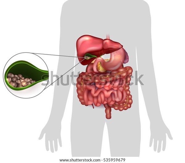 胆嚢の胆石 人のシルエット 周囲の臓器の解剖学 のベクター画像素材 ロイヤリティフリー