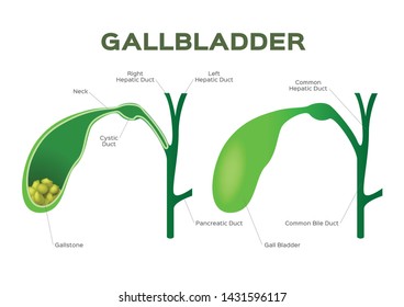 Gallstones Gallbladder Stone Disease Inflammation Vector Stock Vector ...