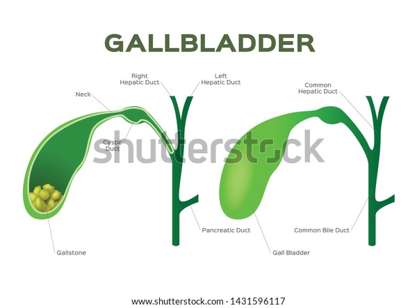 Gallstones Gallbladder Stone Disease Inflammation Vector Stock Vector ...