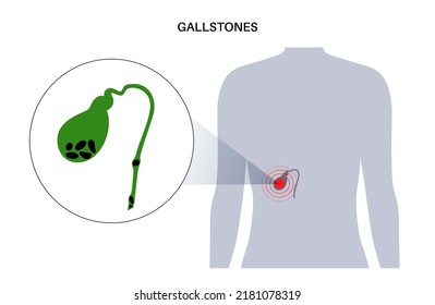 Gallstones In The Human Body. Stones In The Gallbladder, Inflammation In The Digestive System And Abdomen Pain. Human Internal Organ Examination In Clinic Or Hospital. Medical Flat Vector Illustration