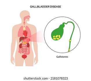 Piedras gástricas en el cuerpo humano. Piedras en la vesícula biliar, inflamación en el aparato digestivo y dolor abdominal. Examen interno de órganos humanos en clínica u hospital. Ilustración vectorial plana médica