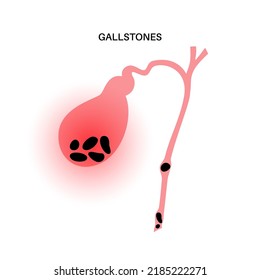 Gallstones In The Human Body. Stones In The Gallbladder, Inflammation In The Digestive System And Abdomen Pain. Human Internal Organ Examination In Clinic Or Hospital. Medical Flat Vector