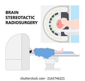 Gamma Tumor Cancer Treat Exam Body X-ray MRI Imaging Scan Medicine Focus Disease Accelerator Central Nervous System Beam CT Linac Linear Particle Oncology Knife Minimally Invasive