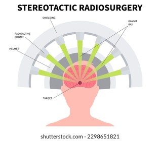 Gamma tumor cancer treat exam body X-ray MRI imaging scan medicine focus disease accelerator central nervous system beam CT Linac linear particle oncology Knife minimally invasive radiosurgery