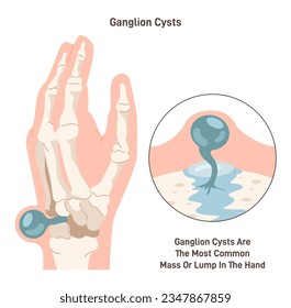 Ganglion cyst. Fluid-filled lump under the skin of a wrist or hand. Synovial cyst over a joint or in a tendon. Flat vector illustration