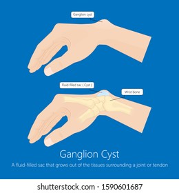 130 Ganglion cyst wrist Images, Stock Photos & Vectors | Shutterstock