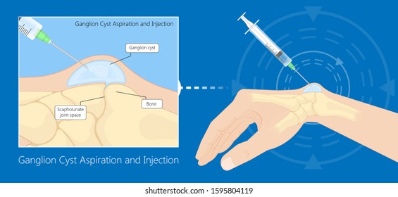 Ganglion cyst small sac of fluid disease hand wrist trauma joint tendon