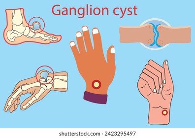 Ganglion quist, blando, gel como masas, liso y redondo,soldadura en la mano, muñeca y pie,Ilustración vectorial médica del quiste del pie de ganglion con huesos. Grandes quistes ganglion, un saco de gelatina como fluido