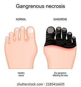 Gangrene. Comparison and difference between healthy foot and leg with tissue death by Gangrenous necrosis. Dry gangrene affecting the toes. Vector poster