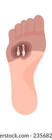 Gangrene Forefoot Disease Vector Illustration
