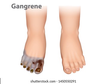 Gangrene is a type of tissue death caused. Diabetic Arterial Disease showing gangrene and ulcerations of the toes.