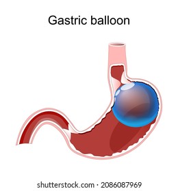 Gastric balloon. Intragastric Balloon Inside a Stomach. weight loss. intragastric surgery. Vector diagram for medical use
