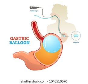 Diagrama del procedimiento médico de globo gástrico, ilustración vectorial. Tratamiento de pérdida de peso y obesidad. Globo inflado en el estómago. 