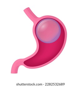 Gastric balloon weight loss. Installation of a gastric balloon into stomach. Methods of weight loss surgery. Human anatomy. Vector illustration. svg