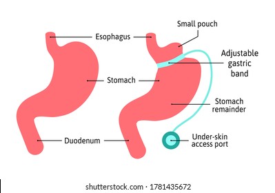 Gastric Band anatomical medical illustration diagram. Surgery divide stomach into two parts with band. Human stomach anatomy isolated on white background. Stomach and digestion organ system, vector svg