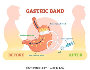 Gastric Band anatomical vector illustration diagram svg