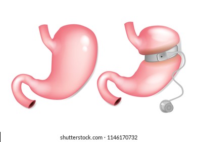 Gastric band before and after. Gastric Banding Surgery