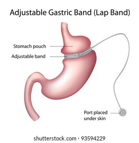 Gastric Band Or Lap Band Weight Loss Surgery