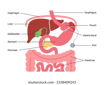 Gastric band medical procedure. AGB stomach surgery concept, obesity problem, weight loss process. Abdomen laparoscopy anatomical poster. Overweight in human body flat vector illustration for clinic