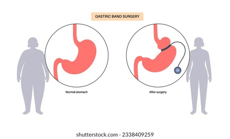 Gastric band medical procedure. AGB stomach surgery concept, obesity problem, weight loss process. Abdomen laparoscopy anatomical poster. Overweight in human body flat vector illustration for clinic