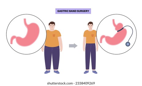 Gastric band medical procedure. AGB stomach surgery concept, obesity problem, weight loss process. Abdomen laparoscopy anatomical poster. Overweight in human body flat vector illustration for clinic