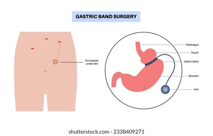Gastric band medical procedure. AGB stomach surgery concept, obesity problem, weight loss process. Abdomen laparoscopy anatomical poster. Overweight in human body flat vector illustration for clinic