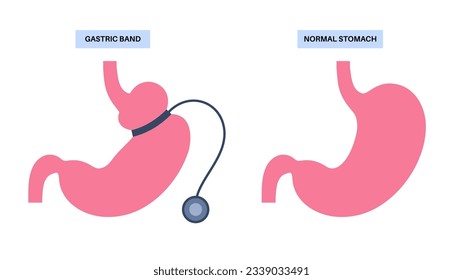 Gastric band medical procedure. AGB stomach surgery concept, obesity problem, weight loss process. Abdomen laparoscopy anatomical poster. Overweight in human body flat vector illustration for clinic