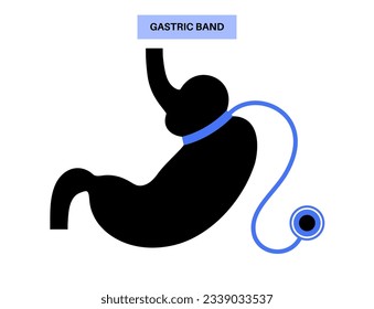 Gastric band medical procedure. AGB stomach surgery concept, obesity problem, weight loss process. Abdomen laparoscopy anatomical poster. Overweight in human body flat vector illustration for clinic
