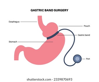 Gastric band medical procedure. AGB stomach surgery concept, obesity problem, weight loss process. Abdomen laparoscopy anatomical poster. Overweight in human body flat vector illustration for clinic