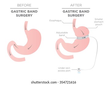 Gastric Band for Weight Loss. 