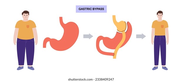 Gastric bypass gastroplasty operation. Male body before and after stomach surgery. Obesity problem, weight loss procedure. Abdomen laparoscopy medical poster. Overweight problem vector illustration
