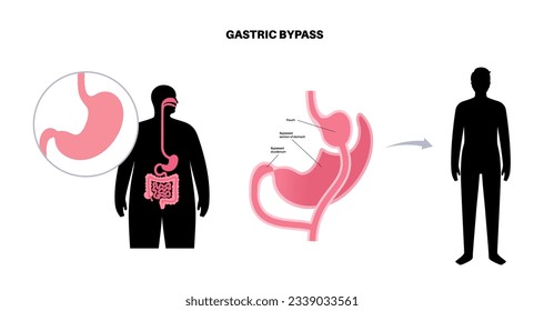 Gastric bypass gastroplasty operation. Male body before and after stomach surgery. Obesity problem, weight loss procedure. Abdomen laparoscopy medical poster. Overweight problem vector illustration