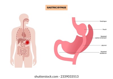 Gastric bypass gastroplasty operation. RYGB stomach surgery concept, obesity problem, weight loss procedure. Abdomen laparoscopy medical poster. Overweight problem in male body vector illustration