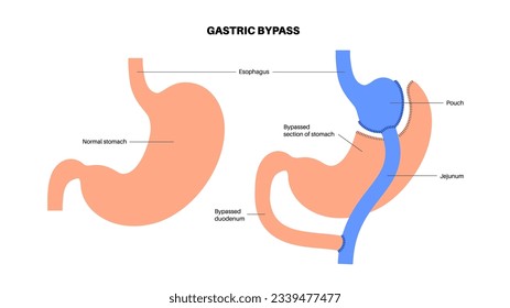 Gastric bypass gastroplasty stomach operation. Human organs before and after surgery. Obesity problem, weight loss procedure. Abdomen laparoscopy medical poster. Overweight problem vector illustration