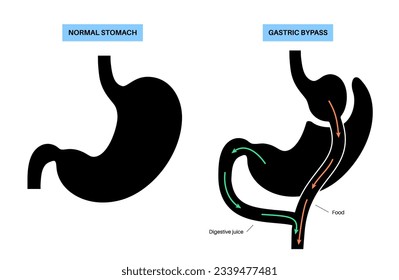 Gastric bypass gastroplasty stomach operation. Human organs before and after surgery. Obesity problem, weight loss procedure. Abdomen laparoscopy medical poster. Overweight problem vector illustration