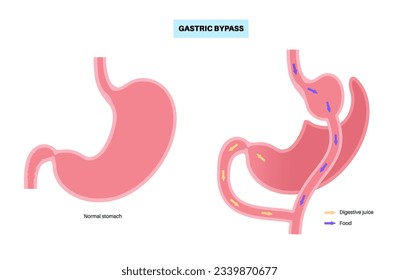 Gastric bypass gastroplasty stomach operation. Human organs before and after surgery. Obesity problem, weight loss procedure. Abdomen laparoscopy medical poster. Overweight problem vector illustration