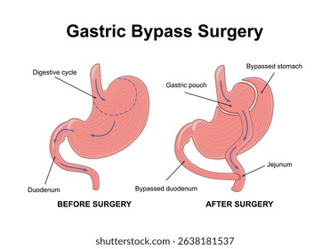 
Gastric bypass gastroplasty stomach operation. Human organs before and after surgery. Obesity problem, weight loss procedure. Abdomen laparoscopy medical poster. Overweight problem vector illustratio
