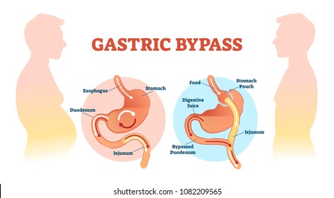 Gastric bypass medical surgery procedure vector illustration with esophagus, stomach, duodenum and jejunum flow. Anatomical diagram with normal stomach and bypassed.