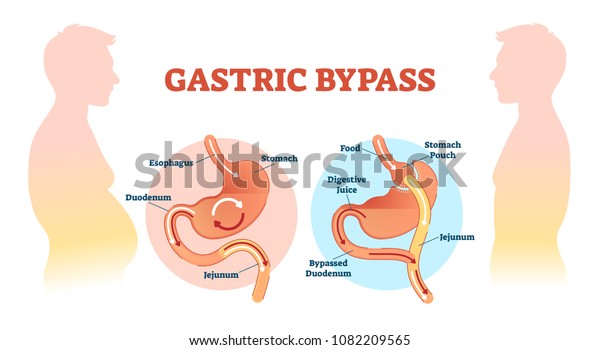 食道 胃十二指腸 空腸流を含む胃バイパス手術用ベクター画像イラスト 正常な胃をバイパスした解剖図 のベクター画像素材 ロイヤリティフリー