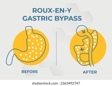  Gastric Bypass RNY Weight Loss Surgery vector illustration icon Roux-en-Y
