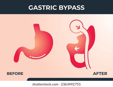  Gastric Bypass RNY Weight Loss Surgery vector illustration icon Roux-en-Y
