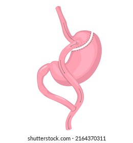 Gastric Bypass Of Stomach. Methods Of Weight Loss Surgery. Bariatry. Human Anatomy Illustration For Infographics, Atlas, Textbook Or Study Material.