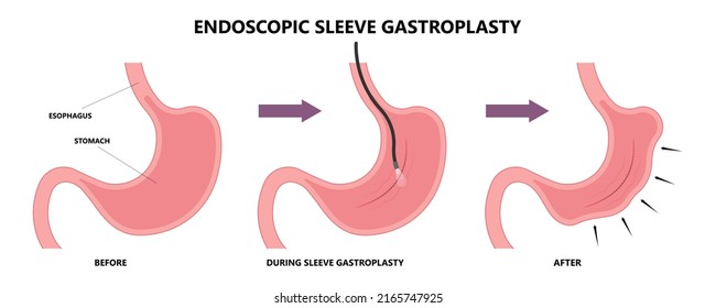 Gastric Bypass Surgery Band Roux En Stock Vector (Royalty Free ...