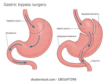 Gastric bypass surgery before and after. Vector illustration. 