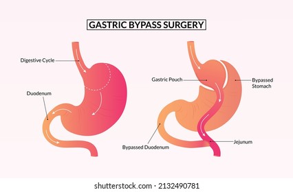 Gastric bypass surgery before and after medical illustration.