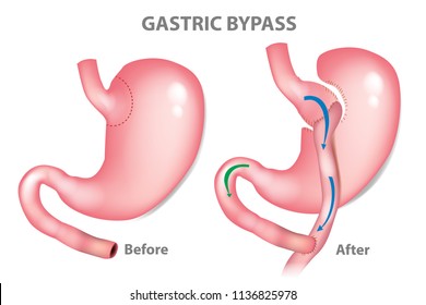 Gastric bypass surgery - RNY (Roux-en-Y ). MINI-GASTRIC BYPASS