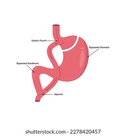 Gastric bypass surgery. Vector illustration.