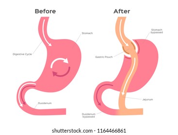 Gastric Bypass Vector / Stomach Anatomy