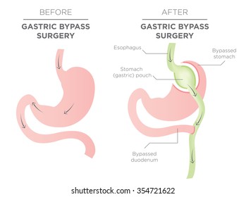 Gastric Bypass for Weight Loss 
